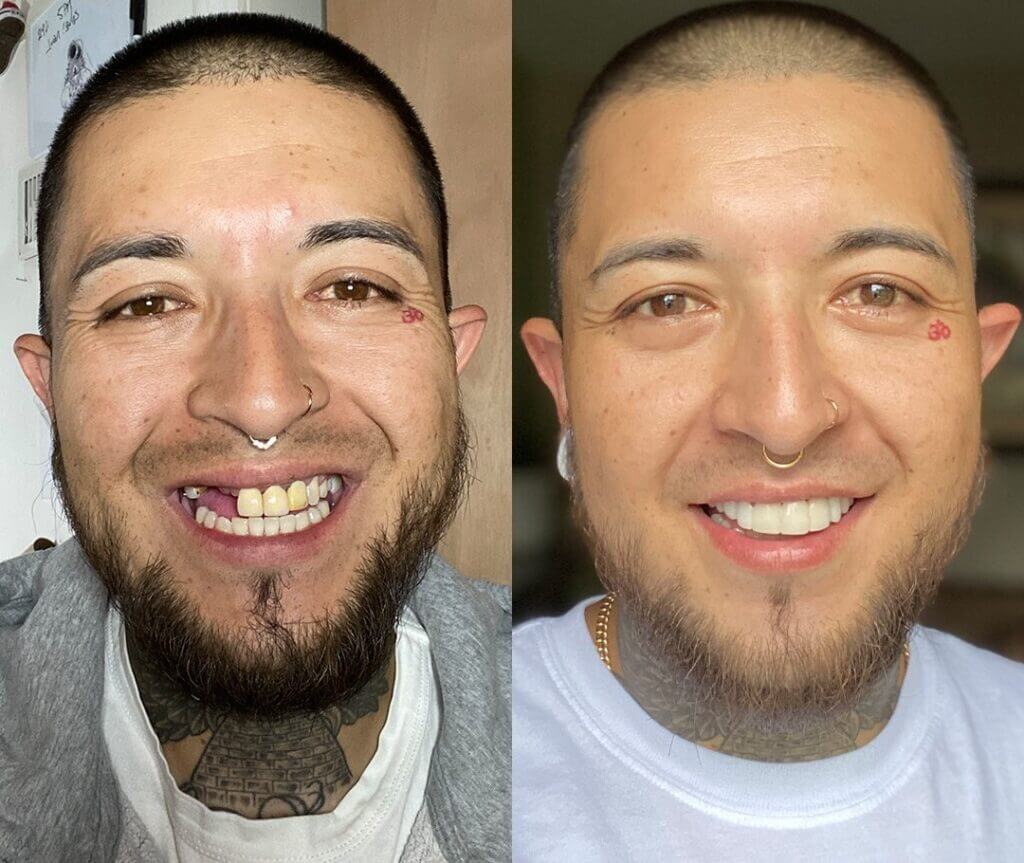 [PAY 1, GET 3] White Dental Lens® - Upper + Lower Kit (FULLY ADJUSTABLE TO ALL DENTAL ARCHES)