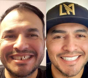 Dental White™ Lenses - Upper + Lower Kit (FULLY ADJUSTABLE TO ALL DENTAL ARCHES)