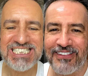 Dental White® Resin Lens - Upper + Lower Kit (FULLY ADJUSTABLE TO ALL DENTAL ARCHES)