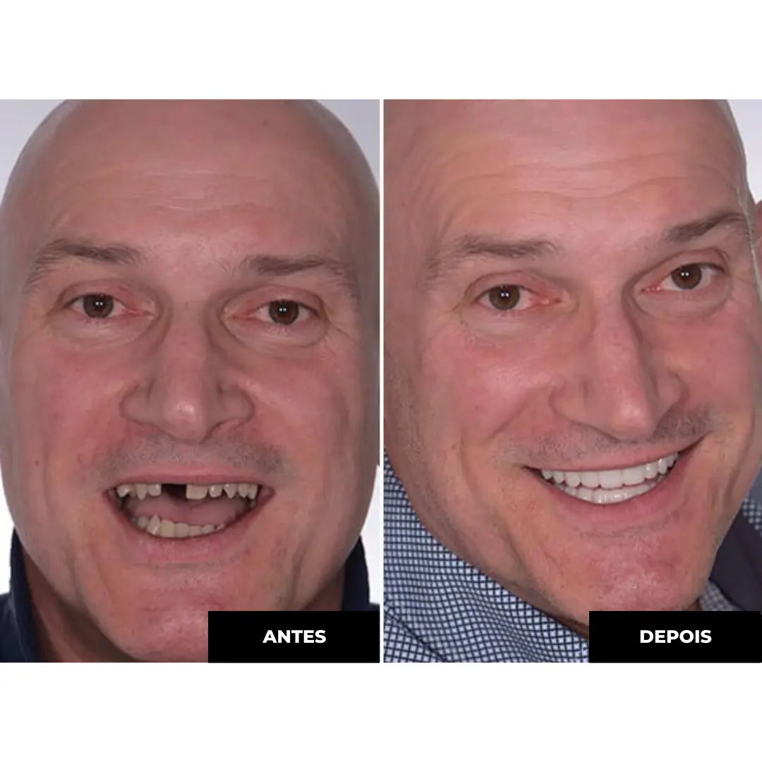 [CONSUMER MONTH PROMOTION] White© Dental Resin Lenses - BUY AND GET THE UPPER AND LOWER KIT + GIFT