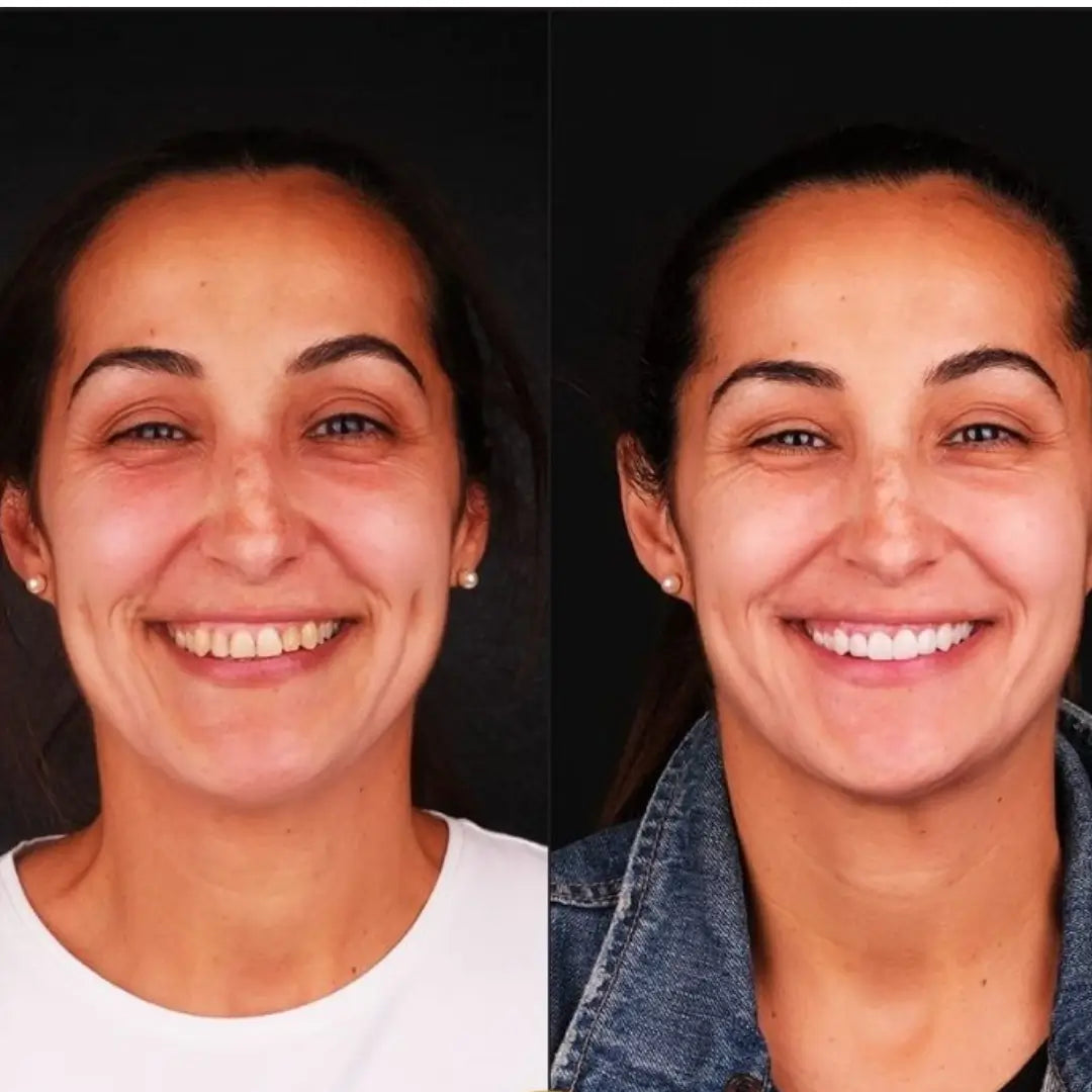 [CONSUMER MONTH PROMOTION] White© Dental Resin Lenses - BUY AND GET THE UPPER AND LOWER KIT + GIFT